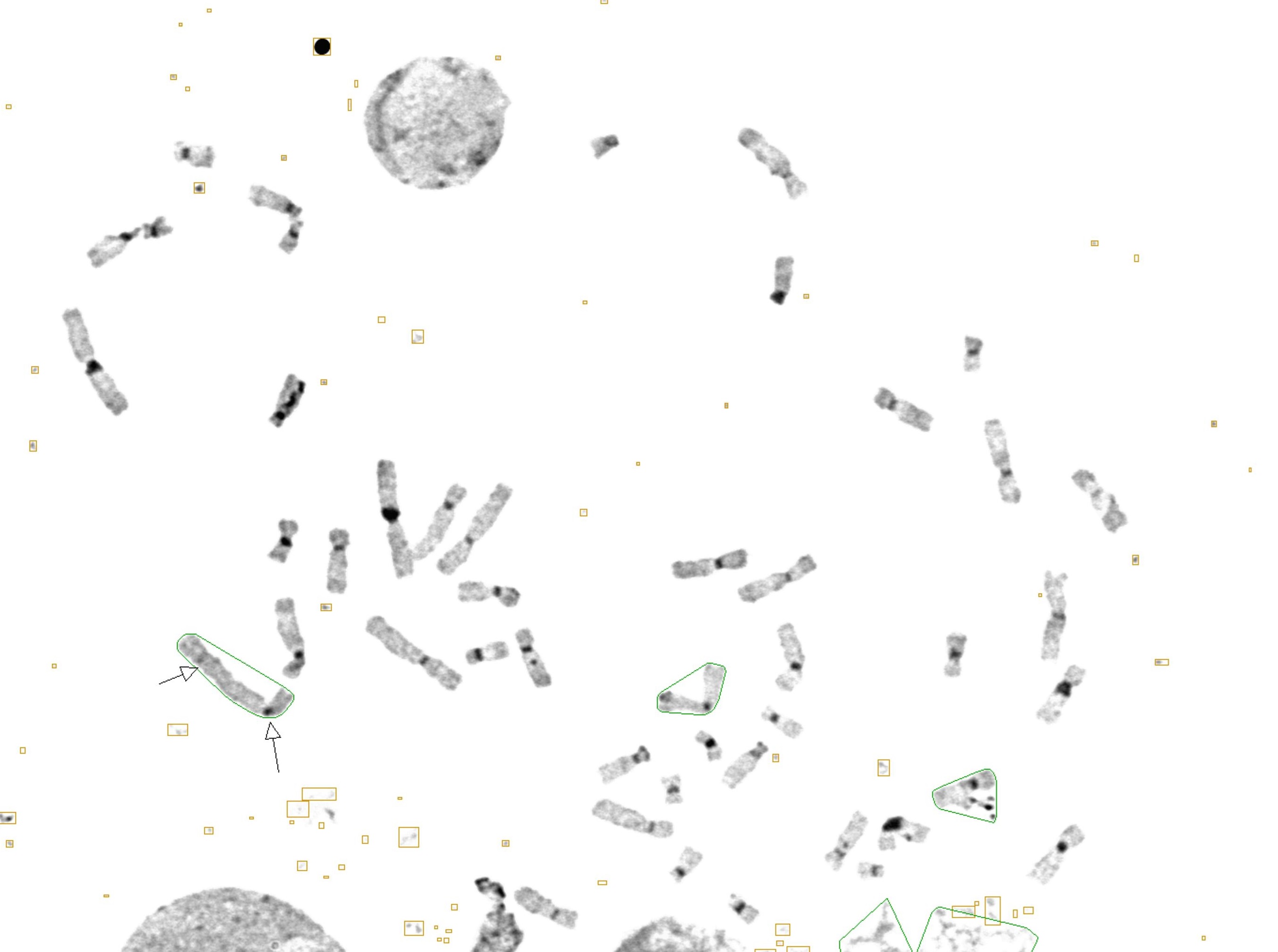 A Rare Case of Isodicentric Xq28 that Causes Mental Retardation: Molecular Characterization and Review