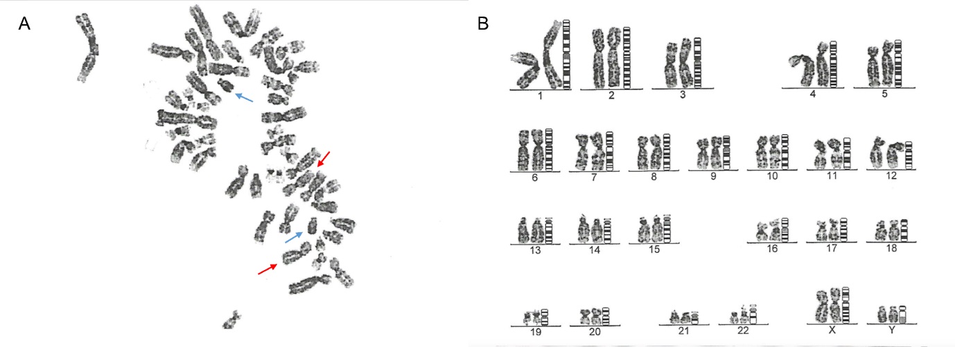 Morbid Obesity and Psychiatric Disorders Hiding a Sex Aneuploidy: A Case of Late Diagnosis of 48,XXYY Syndrome