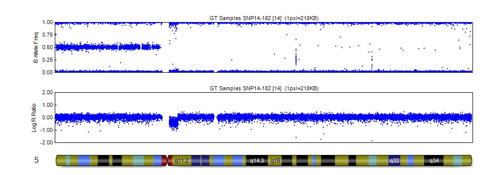 A New Case of Microdeletion 5q11.2 with Segmental 5q Isodisomy and Review of the Literature