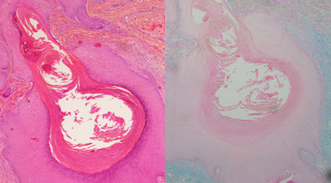 A case of Tuberous Sclerosis Complex Masquerading as Birt-Hogg-Dubé Syndrome