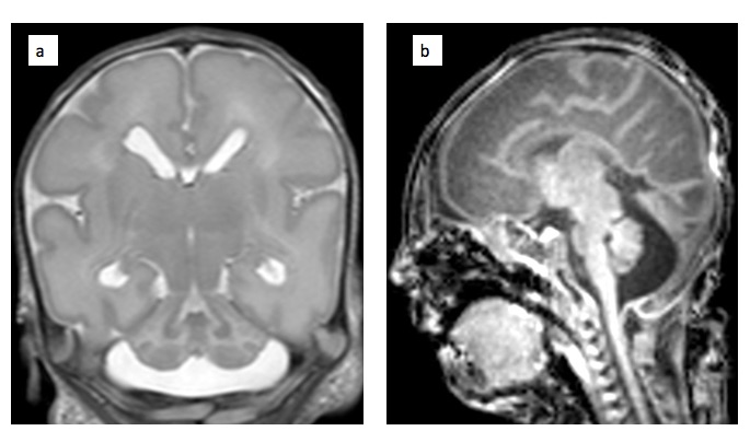 Cerebellar HypoplasÄ±a as a ManÄ±festatÄ±on of 6q25 DeletÄ±on in a Preterm Newborn