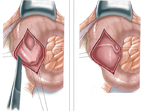 Congenital Ampullary Atresia of the Fallopian Tube and the Coexistence of Fimbrial Tissue