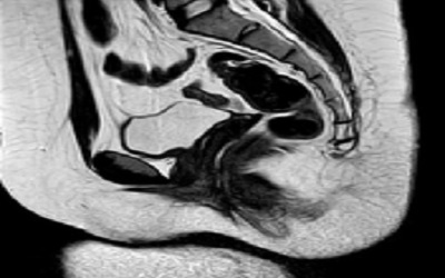 A Review of Radiologic Imaging in Patients with
Androgen Insensitivity