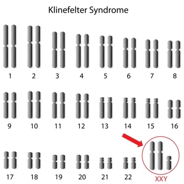 Klinefelterâ€™s Syndrome â€“Unusual Associations