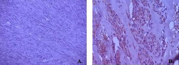 Malignant Spermatic Cord Tumor as a Rare Scrotal Lesion: Case Report and Literature Review