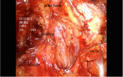 Obturator Neuralgia: Complete Resolution after Laparoscopic Retropubic Sling Removal: A Report of 2 Cases
