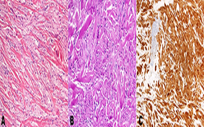 Granular Cell Tumors are Very Rare but Important Vulvar Masses that should not be
Overlooked
