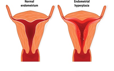 Evaluation of Women with Post-Menopausal Bleeding