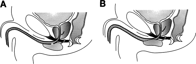 Cowpers Syringocele Revealed by Post-micturition Dribbling in an Adult