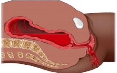 Postpartum Hemorrhage and Active Management of the Third Stage of Labor (AMTSL) in a Sub-Saharan Africa Maternity