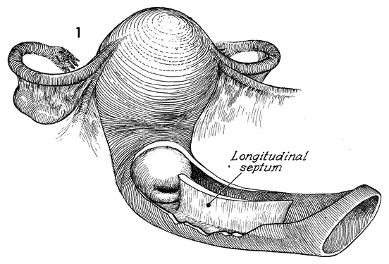 A High Transverse Vaginal Septum