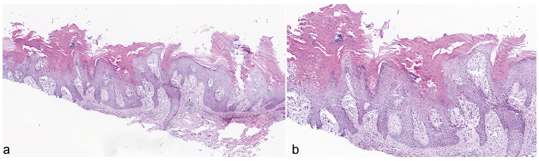 Genital Well-Demarcated Plaques: Whatâ€™s your Diagnosis?
