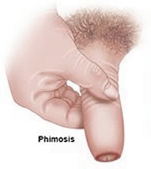 Preputial Abscess Secondary to Phimosis