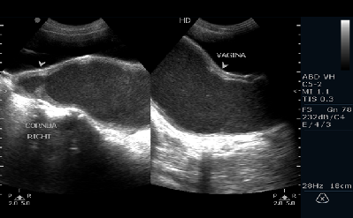 Obstructed Hemivagina with Ipsilateral Renal Anomaly(OHVIRA) Syndrome - A Rare Congenital Anomaly