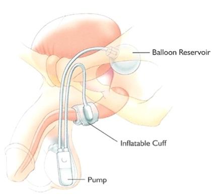 Urethral Diverticula Following Explanation of Artificial Urinary Sphincter