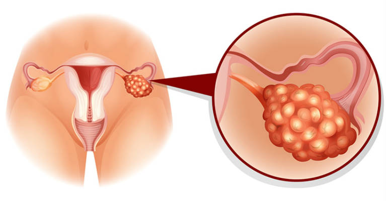 Trends and Profile of Ovarian Cancer at a Medical Institute