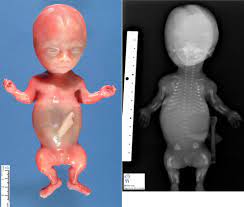 Genetic Diagnosis of Skeletal Dysplasias