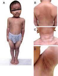 Anesthetic Concerns of Children with Skeletal Dysplasia