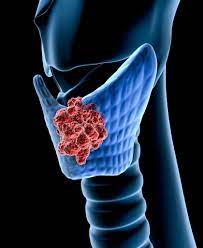 Dietary Selenium Intake and Thyroid Cancer Risk in Postmenopausal Women