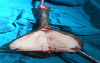 Pedunculated Angiomyxofibroma of Vulva: A Rare Entity Case Report