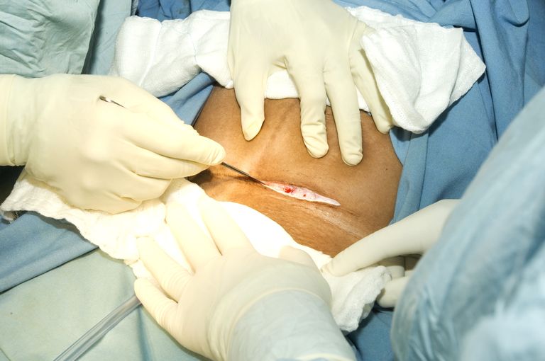 Outcome of Multiple Caesarean Sections
