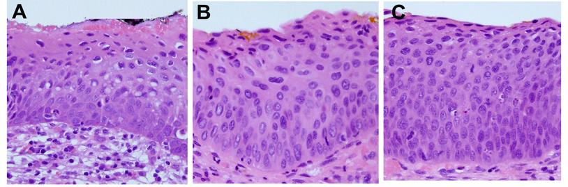 Residual Lesion after Cervical Intraepithelial Neoplasia Grade 2/3 Treatment – The Experience
of Our Cervical Pathology Unit