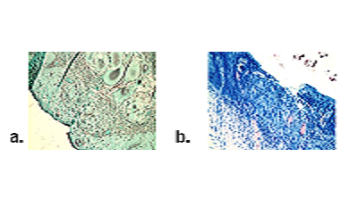 Sarcoidosis of the Cervix: An Unusual Case Presentation