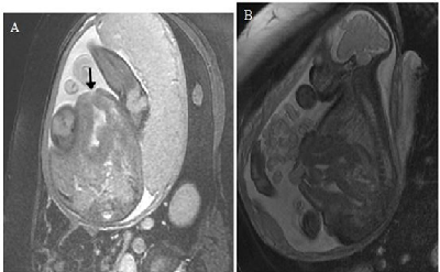 Urororectal Septum Malformation Sequence: A Case
Report