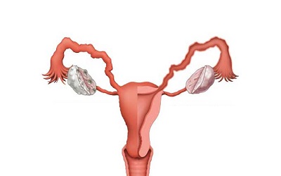 Hirsutism in PCOS - Low Satisfaction of Treatment and its Background