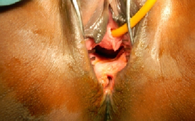 Chronic Third and Fourth Degree Perineal Tear Following Obstetric Trauma- A Case Series