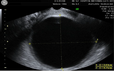 Macroscopic and Ultrasound Evaluation of a Giant
Sub mucosal Leiomyoma with Cystic Degeneration:
Differential Diagnosis