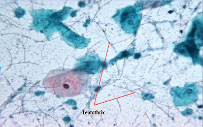 Vaginal Leptothrix: From Fungi to Lactobacillosis
