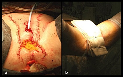 Feminizing Genitoplasty for Children with Disorders of Sex Development