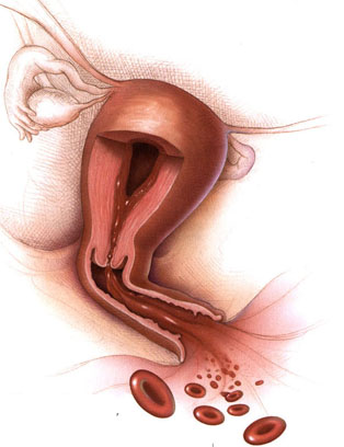 Uterus Didelphys with Septate Cervix and Unilateral Endometrial Carcinoma: A Case Report