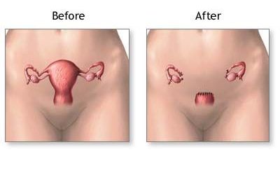 Uterine Sarcoma Presenting in the Setting of Non-puerperal Uterine Inversion with Uterine Prolapse