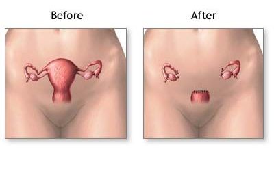 Uterine Sarcoma Presenting in the Setting of Non-puerperal Uterine Inversion with Uterine Prolapse