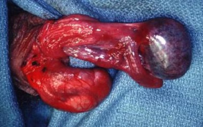 Segmental Testicular Infarction: A Clinical Dilemma