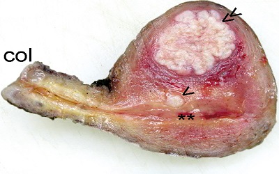 Undifferentiated Uterine Sarcoma with associated
Lipoleiomyoma