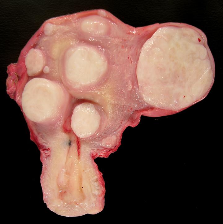 Leiomyoma through History: An Overview