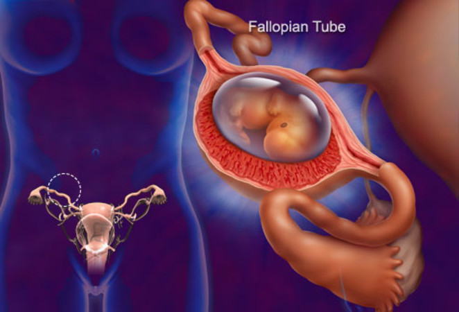 Bilateral Tubal Ectopic Pregnancy: Case Report of
Ectopic Pregnancy Following Intrauterine Insemination