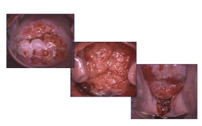 Cervical Cancer Screening: The Challenges of Tracking and Follow-up