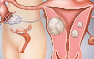 Laparoscopic Management of Fallopian Tube Torsion
Associated with a Paratubal Cyst in a 13-Year-Old
Adolescent Girl