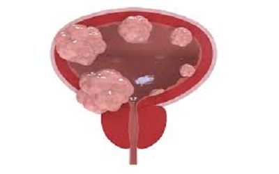 Hemorrhagic Shock Caused by Solitary Fibrous Tumor of the Urinary Bladder: Case Report and Review of the Literatures