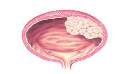 Screening Workers Exposed to 4,4â€™-Methylenebis(2- Chloroaniline) (MBOCA) for Bladder Cancer in Taiwan