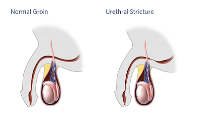 Urethral Stricture after Transurethral Resection of Prostate: Role of Maintaining the Temperature of the Urethra with Warm Irrigation Solution