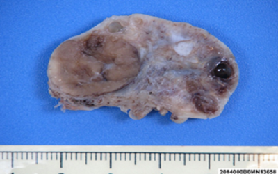 Clinical Manifestation, Diagnosis and Histology of Ovarian Luteoma: Case Report of Female Virilisation and Review of the Literature