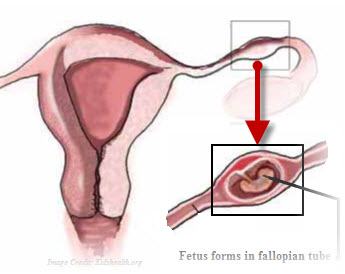 Cesarean Scar Ectopic Pregnancy: Three Cases
Illustrating Divergent Treatment Options Where No Standard Management Exists