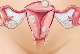 Urethrovaginal Fistula Following Vaginal Prolapse of a Pedunculated Uterine Myoma: A Case Report