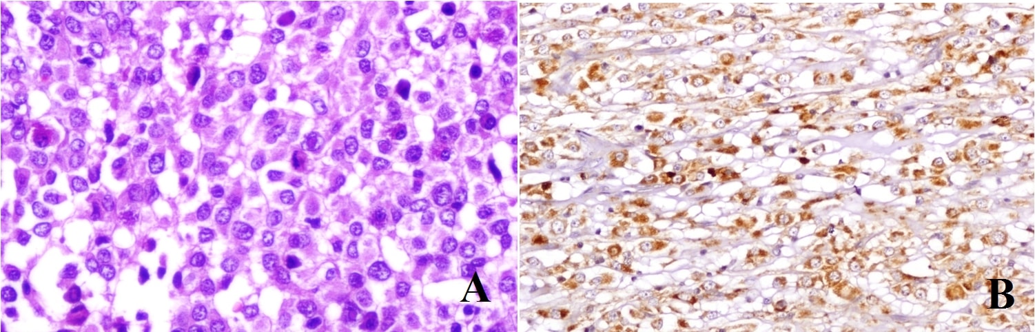 Testicular Gastrointestinal Stromal Tumor (GIST): An Extremely Unusual Secondary of Gastric Primary