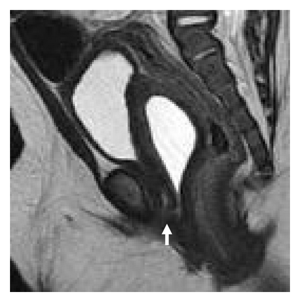 Mullerian Duct Cyst Revealed by Dysuria: A Rare Case Report